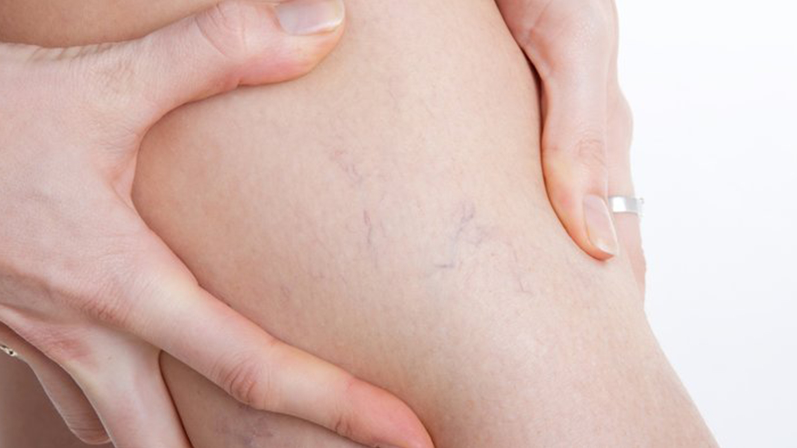 uzmani acikladi varis hastalari sicaklarda nelere dikkat etmeli qJIfLYE3